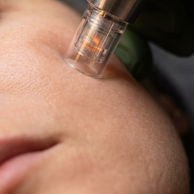 Microneedling 3 Series Package at The Skin Bungalow Aesthetic Studio in Arvada, CO
